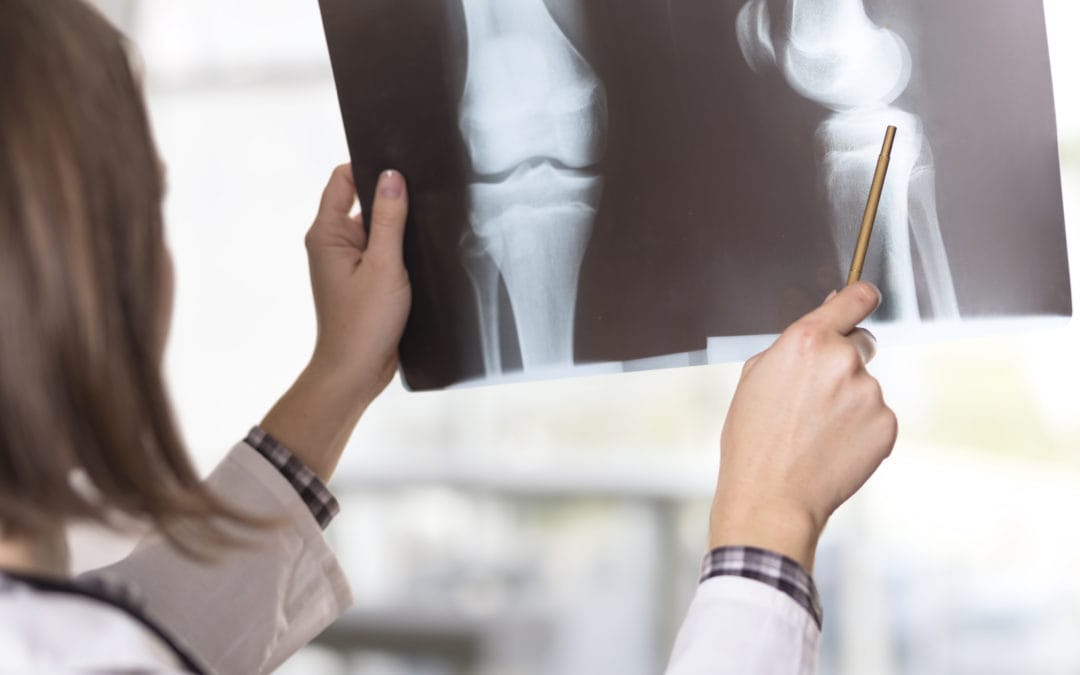 the-effectiveness-of-knee-microfracture-surgery-regenexx-benefits